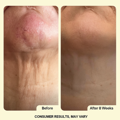 Zerena™ Neck Stick